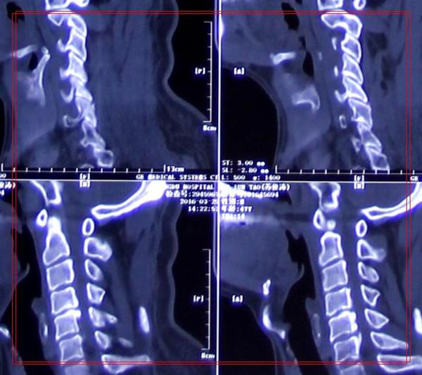交感型颈椎病忌讳什么锻炼方法,交感型和椎动脉型颈椎病区别