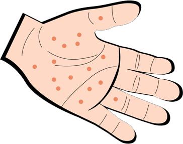 一点都不“单纯”的单纯性疱疹，中医却能轻松搞定！