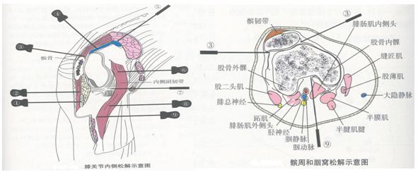 针刀治疗膝关节炎最好的方法,膝骨性关节炎的中医外用治疗