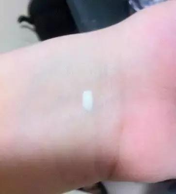 果酸换肤和激光祛痘哪个效果好,激光祛痘和果酸换肤哪个好