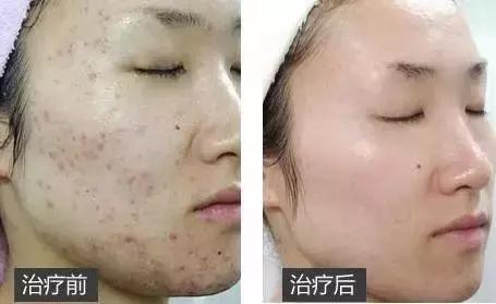 果酸换肤和激光祛痘哪个效果好,激光祛痘和果酸换肤哪个好