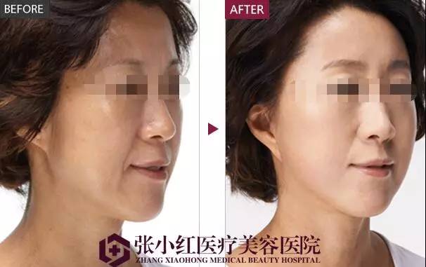 线雕对抗面部衰老的秘密,线雕抗衰依靠三方面的力量