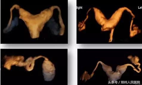 超声造影你了解多少,超声造影什么意思