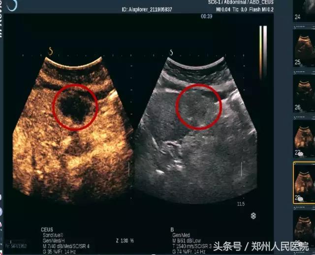 超声造影你了解多少,超声造影什么意思