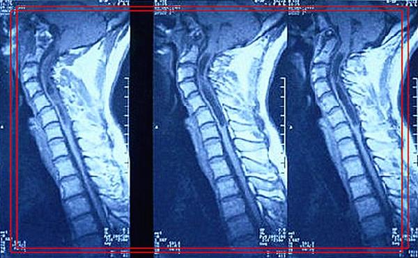 小脑扁桃体下疝畸形患者,小脑扁桃体下疝畸形的临床表现
