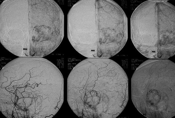 海绵窦海绵状血管瘤,海绵窦区海绵状血管瘤发病年龄
