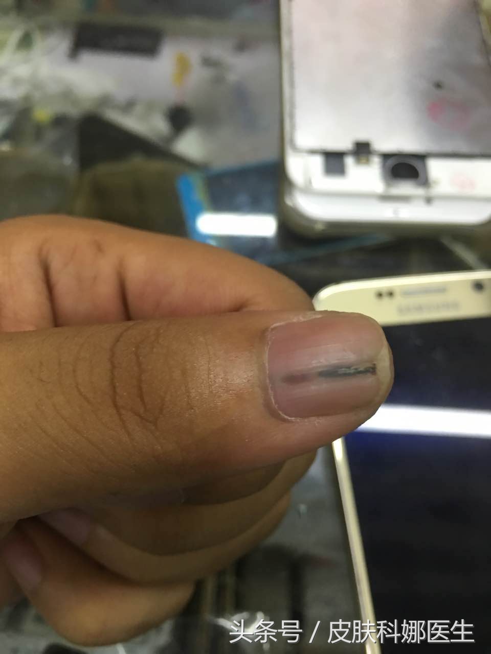 指甲里像扎了竹签一样痛什么原因,指甲壳里扎刺又肿又痛