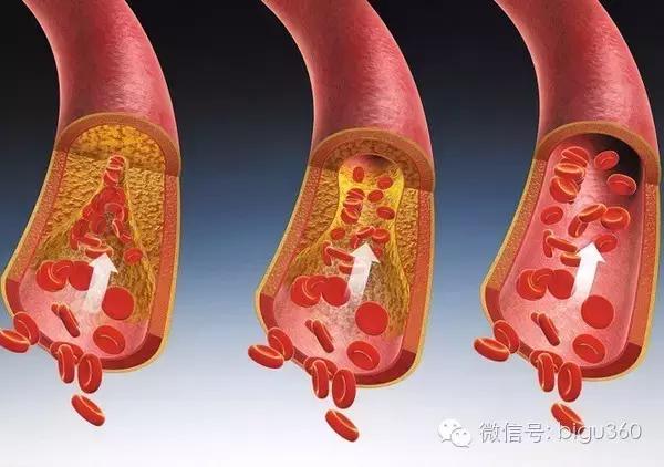 辟谷对血管堵塞有功效吗,辟谷对动脉粥样硬化有效吗