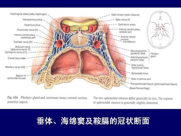 海绵窦海绵状血管瘤,海绵窦区海绵状血管瘤发病年龄