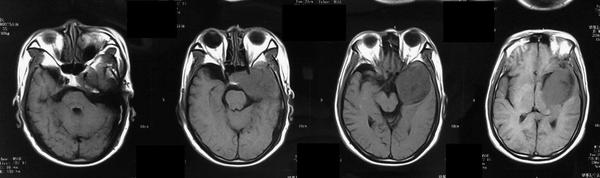 海绵窦海绵状血管瘤,海绵窦区海绵状血管瘤发病年龄