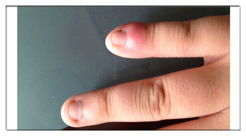 女子拔倒刺感染致整个指甲被拔掉,拔了根倒刺为什么会截肢