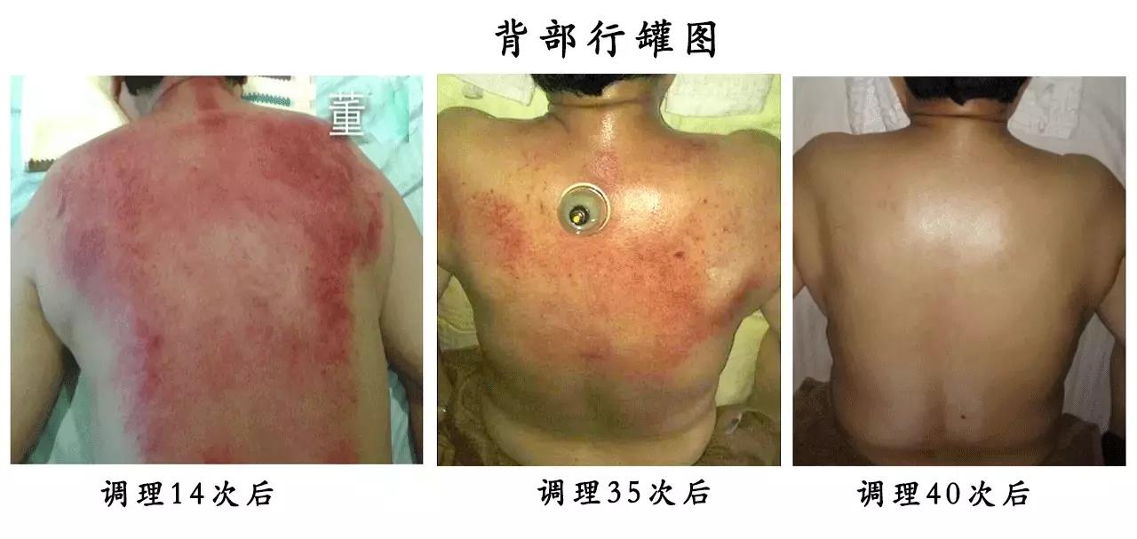 你还不懂美尼尔综合症是啥,她已经可以自愈了