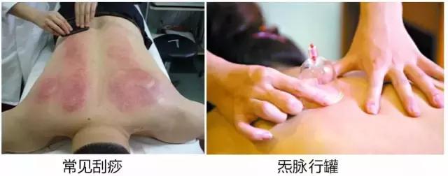 刮痧哪种罐比较好,魔灸罐与刮痧区别