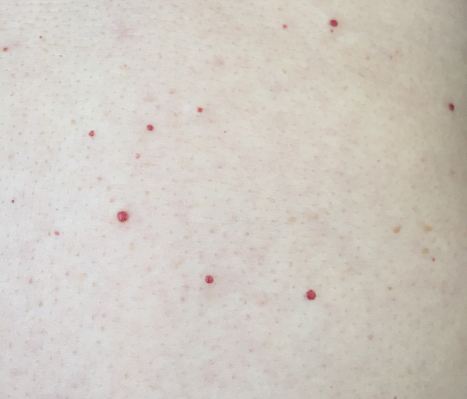 全身出现类似樱桃瘤红点,突然长了一个跟刺猴一样的疙瘩