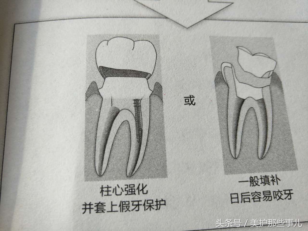 蛀牙怎么知道龋坏到牙神经了,蛀牙痛到神经怎么办