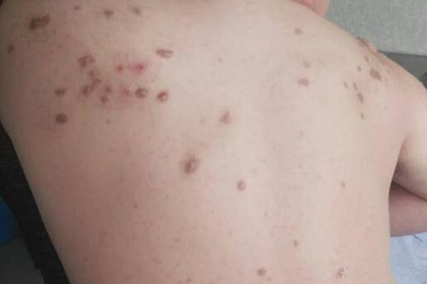 前方高能！吸食*毒冰**后皮肤症状（图文）