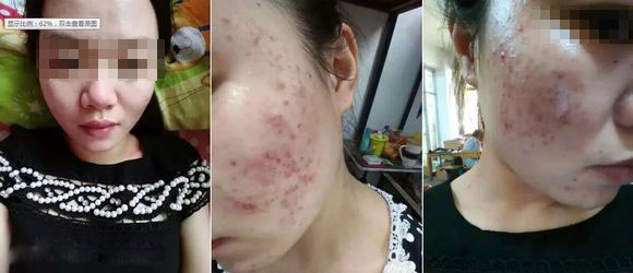 脸上的痤疮是什么原因导致的,你不在意的举动