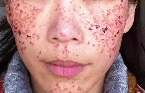 果酸换肤和激光祛痘哪个效果好,激光祛痘和果酸换肤哪个好