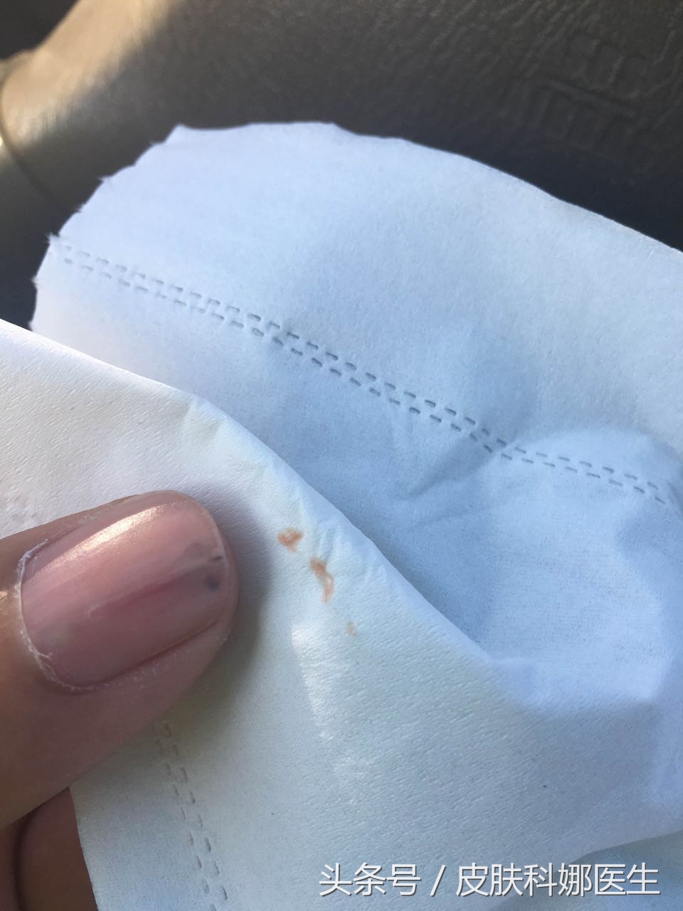 指甲里像扎了竹签一样痛什么原因,指甲壳里扎刺又肿又痛