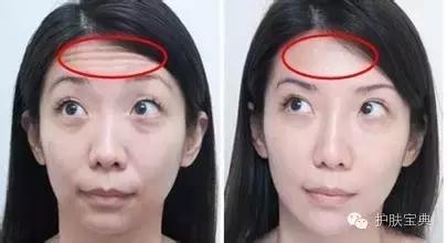 特别在意抬头纹怎么办,有人会在意抬头纹么
