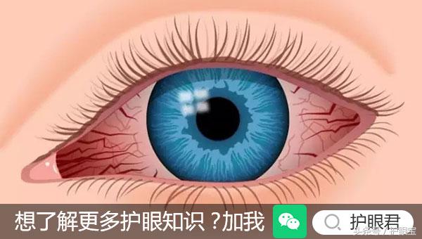 眼内有血丝且容易疲劳,眼白处的血丝一直消不掉