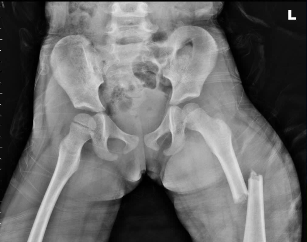 孩子不小心误食了酒精会死吗,小孩误食工业酒精怎么办