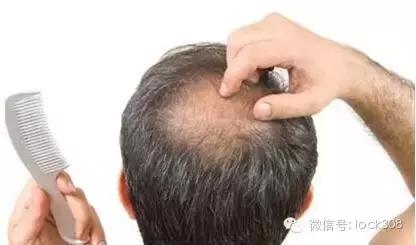 头顶稀疏发缝宽脂溢性脱发怎么办,前额头顶脱发稀疏细软怎样办