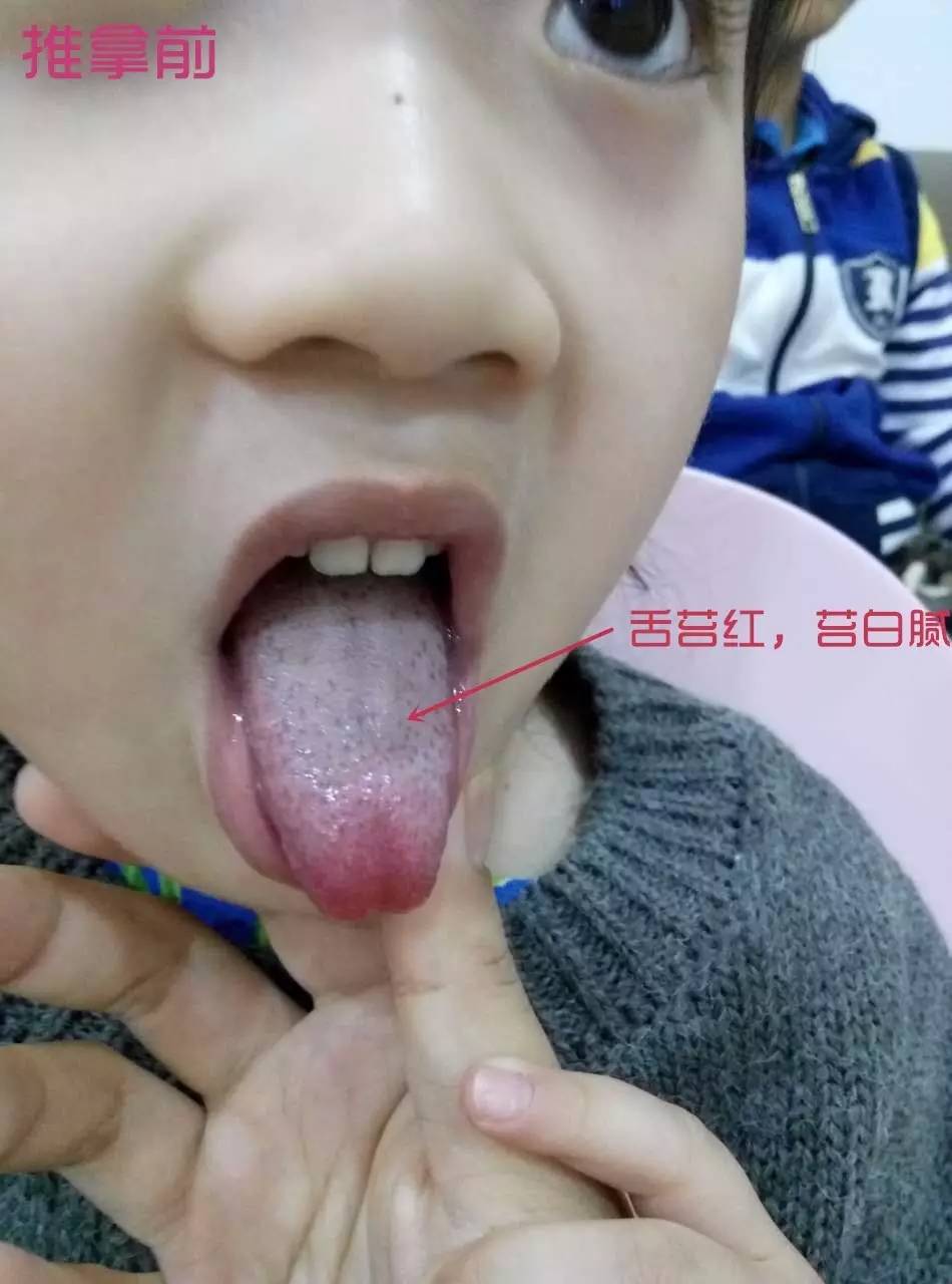 中医如何调理过敏性体质,过敏性体质的孩子怎么调理