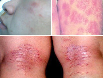 过敏性皮炎止痒小妙招,过敏性皮炎擦什么软膏