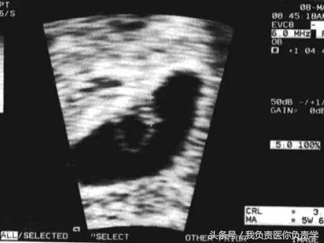 早孕彩超未见胚芽,早孕彩超无回声
