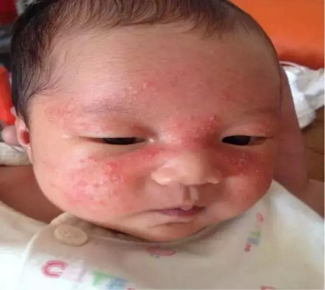 宝宝湿疹反复发4步轻松搞定,宝宝湿疹反反复复怎么根治