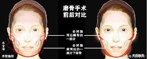 沈梦辰下巴真实照片,沈梦辰取鼻假体