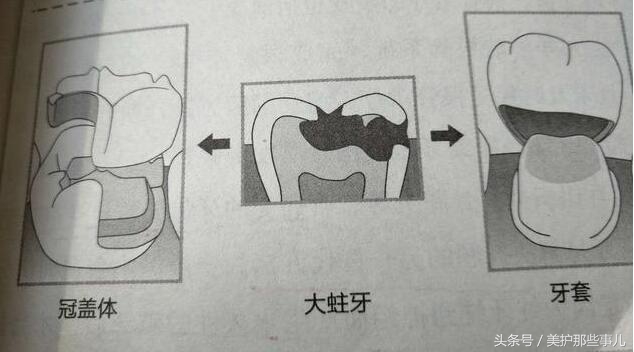 蛀牙怎么知道龋坏到牙神经了,蛀牙痛到神经怎么办
