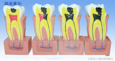 蛀牙怎么知道龋坏到牙神经了,蛀牙痛到神经怎么办