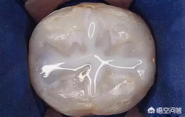 简述如何帮助学前儿童预防龋齿,儿童氟化泡沫预防龋齿有必要吗