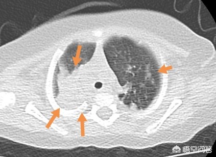 咳嗽肺炎的概率,咳嗽怀疑是新冠肺炎怎么办