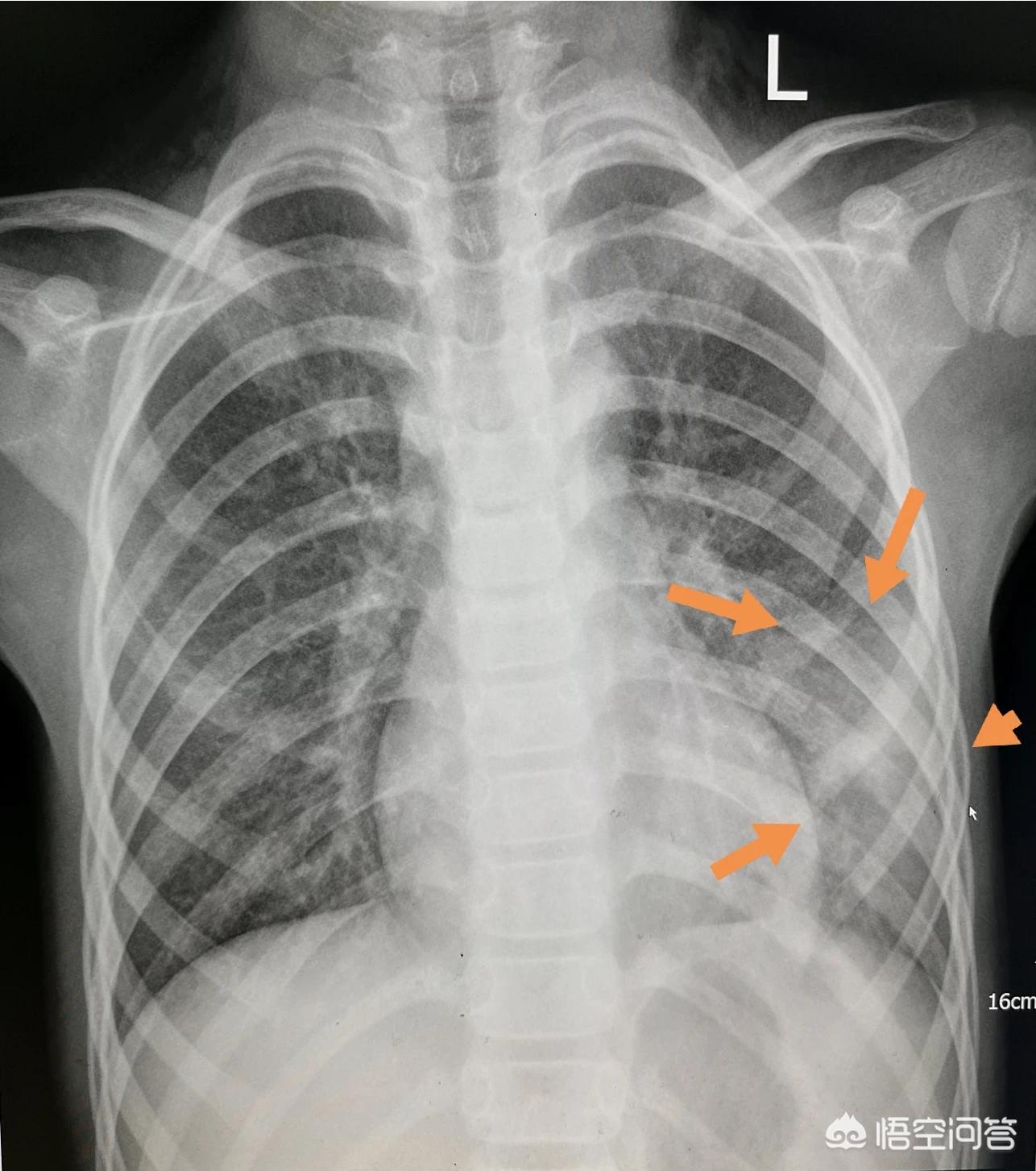 咳嗽肺炎的概率,咳嗽怀疑是新冠肺炎怎么办