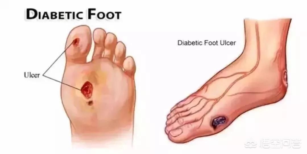 糖尿病足患者脚部症状提示,糖尿病并发症在脚部的症状有哪些