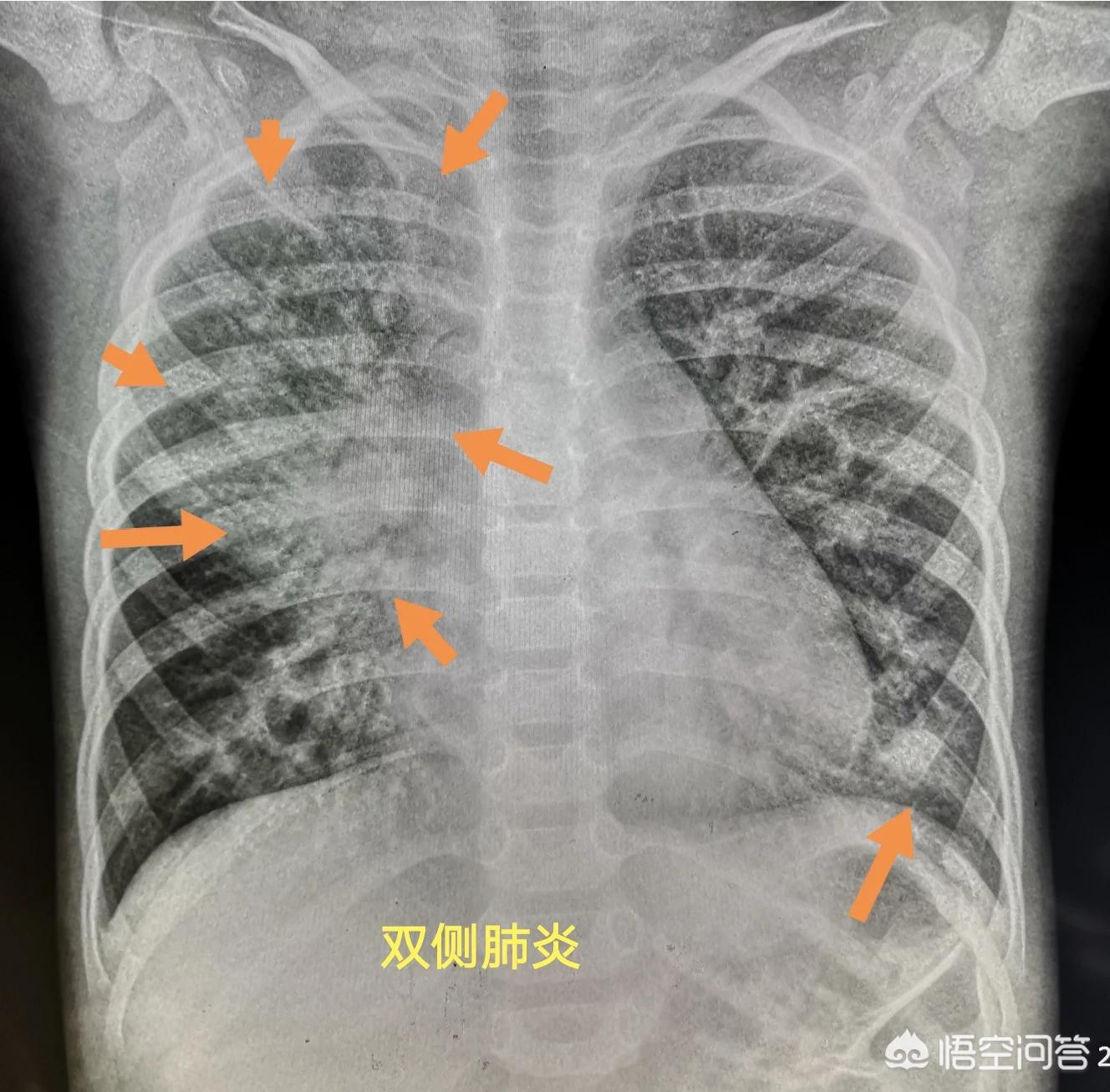 咳嗽肺炎的概率,咳嗽怀疑是新冠肺炎怎么办