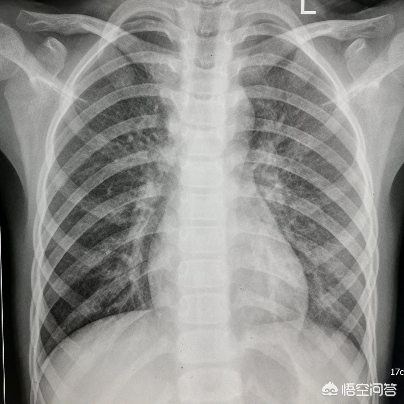 咳嗽肺炎的概率,咳嗽怀疑是新冠肺炎怎么办