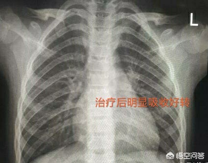 咳嗽肺炎的概率,咳嗽怀疑是新冠肺炎怎么办