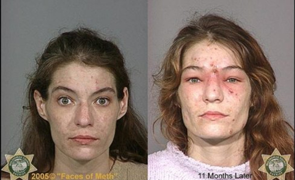 前方高能！吸食*毒冰**后皮肤症状（图文）