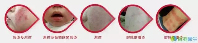 不要小看过敏记住这两点,健康干货避免过敏牢记四条原则