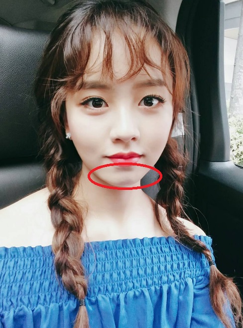 脸部不同部位痘痘代表什么,不同的痘痘要用不同的方法处理