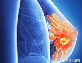 乳腺纤维腺瘤会有刺痛感吗,乳腺纤维腺瘤三类什么意思