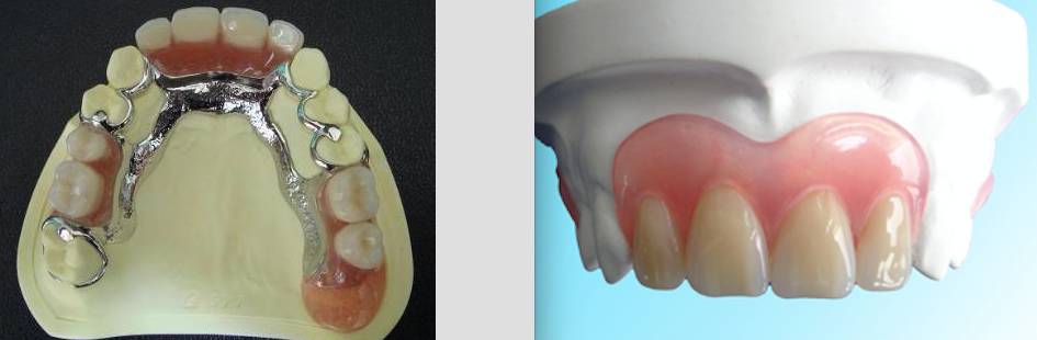 牙科镶牙全过程,口腔科普镶牙全过程图