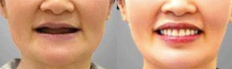 牙科镶牙全过程,口腔科普镶牙全过程图