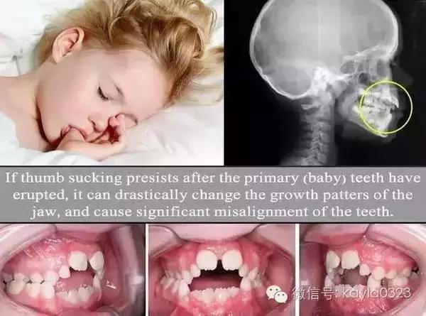 怎么解决孩子吃手的习惯,孩子吃手怎么办才能戒掉