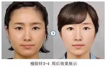 瘦脸针打完多久效果最明显自然,打瘦脸针笑容僵硬怎么能恢复快点