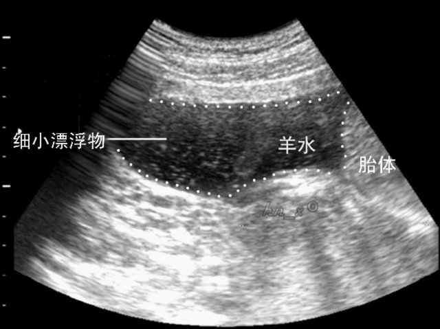 孕妇一天不喝水羊水会变少吗,一天不喝水羊水就少怎么回事